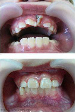 причины аномалии формы зубов